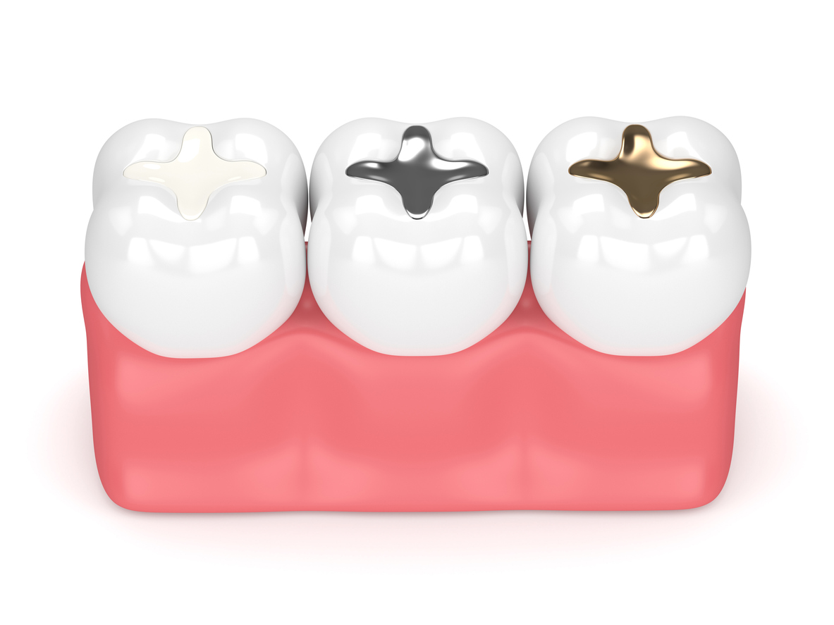 Composite Fillings for Tyson Family Dental offering dental services for the entire Fort Worth Metro Area out of our dentist office in Benbrook Texas